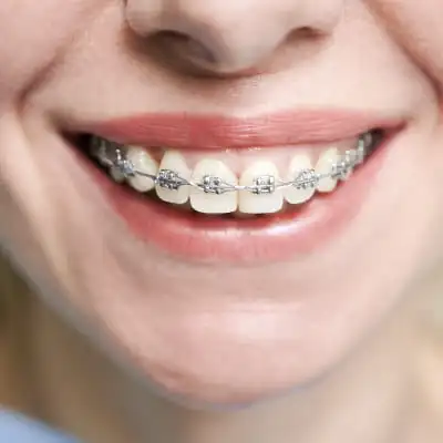 uma boca feminina com dentes utilizando aparelho ortodôntico