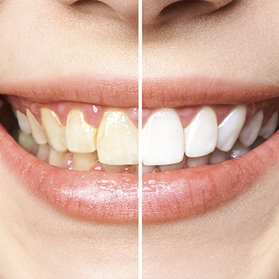 antes e depois do um clareamento dental